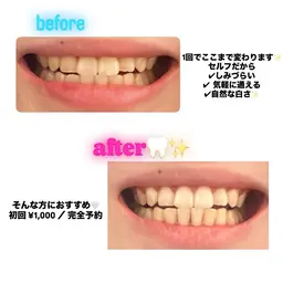 セルフホワイトニング スタンダードコース