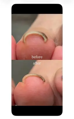 10名限定!【牽引機➕プレート】巻き爪ケア