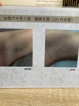 【特価】選べる4箇所脱毛