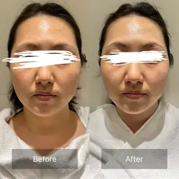 ✨️【炭酸カーボキシーパック＆ドライヘッドスパ】口コミ投稿で200円引き✨