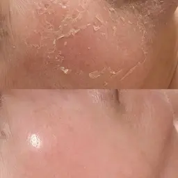 【5daysご予約の方専用】アフタートリートメント