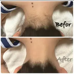 襟足脱毛(毛処理あり)