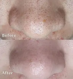 毛穴洗浄 90分 レディースメンズOK👌