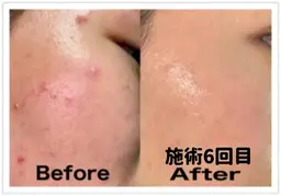 🔶美顔🔶【3つのマシンで深層から毛穴/ニキビケア】毛穴洗浄+イオン導入+ポレーション アクネ菌を抑制します!