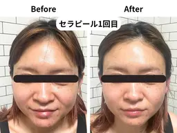 【期間限定】セラピール＋毛穴洗浄¥10000→¥6800