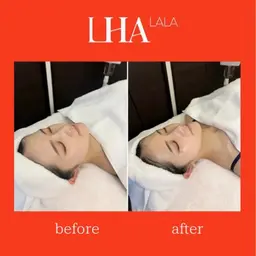 《黒ずみ&くすみ徹底ケア✨ 水流洗浄×再生でつるん肌に!》毛穴洗浄+ララピール