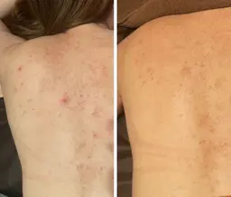 ハーブピーリング🌿背中