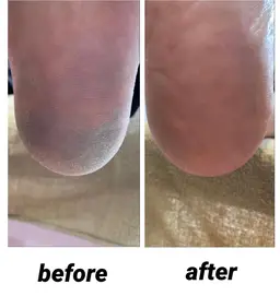 ワンランク上の足の裏の角質ケア🦶魚の目 タコ【指の毛脱毛付き!!】フワフワかかとに【ガサガサかかとの方オススメ】
