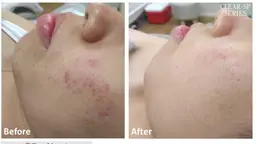 【酵素パック】古い角質・毛穴汚れを酵素で除去するピーリングパック