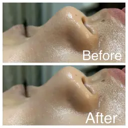 今話題の⭐️毛穴エクストラクション⭐️最強毛穴撲滅メニュー！！ブラックへッドから毛穴の開きまで、毛穴の事ならお任せ！