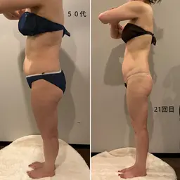 ハイパーナイフEx全身フルコース(顔除く)(90分)