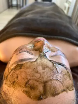 【お肌リボーンキャンペーン✨】剥離ありハーブピーリングレベルソフト14,000円→9,800円❣️❣️