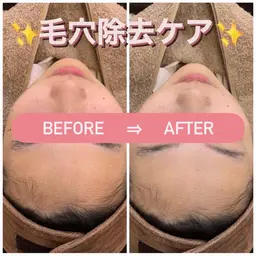 🩵毛穴コース🩵様々な機械を使ってザラつきの無い肌へ✨️✨乾燥/毛穴/黒ずみ/ピーリング/フェイシャル