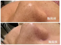 【毛穴洗浄】1番目立つ鼻のざらつき&角栓除去！毛穴の奥からしっかり吸引！初回限定♪