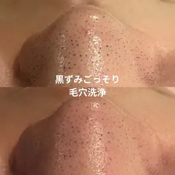 🌸3月限定(条件あり)🌸毛穴洗浄(ピーリング込み)|黒ずみ・角栓ごっそりケア