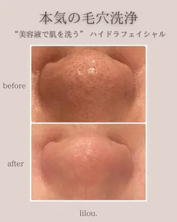 ⚠️人数限定⚠️人気no.2‼️【毛穴洗浄】✨美容液で洗う肌✨ハイドラ毛穴洗浄合わせ