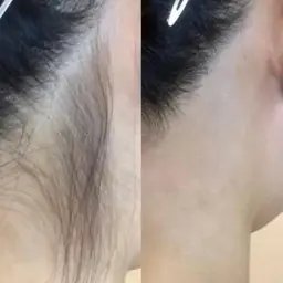 うなじ美人コース🎀口コミ🈹補足必読❣️メンズ🉑