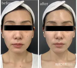 顔キャビ痩身☆モニター募集　3800円税込