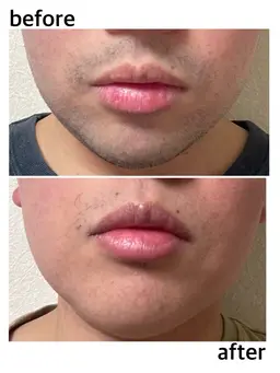 【男性限定】ヒゲ脱毛🧔‍♂️⇾👨 毎日のヒゲ剃りから解放され、清潔感のある印象に✨