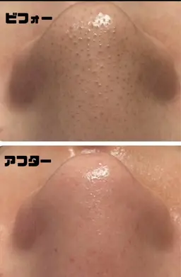 いちご鼻　毛穴洗浄　気になるお鼻の黒ずみや毛穴の汚れをさっぱりスッキリしましょう✨