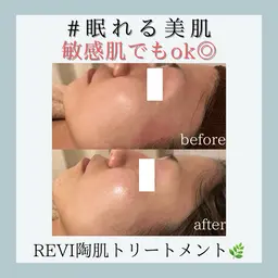 人気No.1！REVI陶肌トリートメント(剥離なしハーブピーリング)★口コミ、ビフォーアフター写真必須
