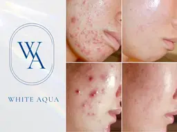 ハーブピーリング ダウンタイムなし