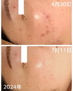 【ニキビ】ハーブピーリング+毛穴洗浄&血流リンパマッサージ+美容液導入　70分