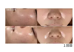 1日垢抜け❣️ハイドラスプラッシュ💦×REVIハーブピーリング🌿