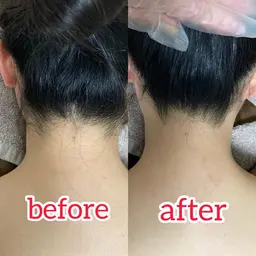 うなじ美人に✨うなじハイブリッド脱毛