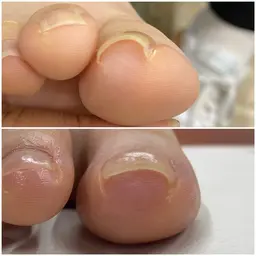 巻き爪、変形爪のモニター募集します（必ずレビュー投稿お願いいたします）