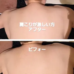 肩こりにキャビテーション