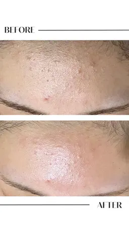 学割U24限定！肌質別で選べる大人気ピーリング🌿【飛び出る毛穴吸引+毛穴ケアorニキビケアor乾燥ケア】