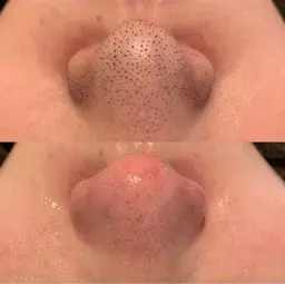 毛穴エクストラクション＋エレクトロクレンジング＋パック＋導入（デコルテマッサージ付）👃🏼