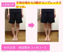 O脚・X脚矯正【脚の歪み・膝の隙間・脚のむくみ】細身のパンツが苦手な方へ