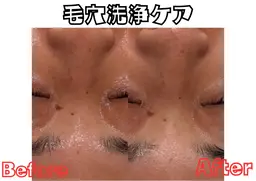 【5名限定！！】毛穴掃除付き！フェイシャルエステ♡