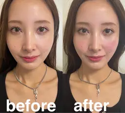 🉐1月15日限定🎍最強変化⚡️正月太りのお顔をスッキリ😆❣️14550円→8000円【電気美容鍼+頭皮鍼+頭首】