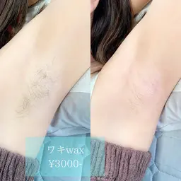 わきワックス脱毛
