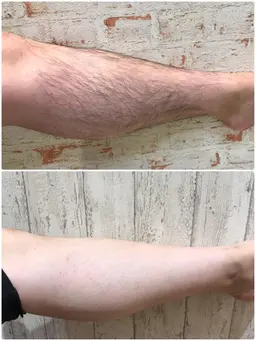 【2026.3.25​〜​3.31限定】男の身だしなみ☆メンズ限定脱毛都度払いメニュー（ヒゲ➕膝下➕足指)ミニモ限定