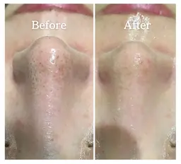 《シミ/くすみ/毛穴の開き/角栓》塗る白玉注射◆極上美白ハイドロfacial