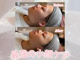 《口コミ割★小顔セット》輪郭をU字からV字へ💆🏼♀️🌿🌿