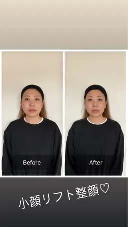 1回で変化がわかる小顔矯正/たるみ、浮腫み、リフトアップ