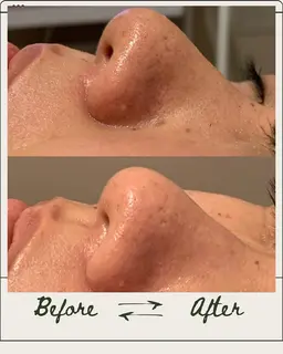 【モニター募集】鼻または頬のみ‼️ 毛穴の黒ずみ・開き・ゴワつきも一回でスッキリ‼️ハイドラフェイシャル