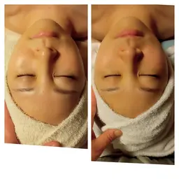 リフトアップフェイシャル