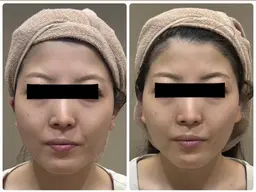 ✨人気No.1✨お顔の脱毛ならお任せください✨毛＆毛穴の両方にWの効果で毛穴レス肌🫧IPL照射で効果絶大の声多数！