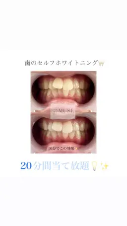 🌸2026年3月ご卒業予定の方限定🌸お試しセルフホワイトニング20分間当て放題🦷✨