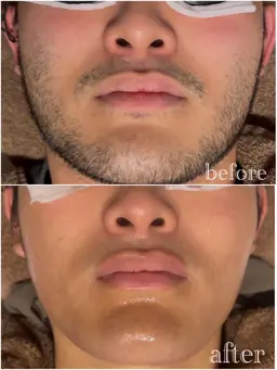 顔脱毛メンズ🥸+毛穴ケア
