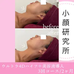 ✨1月限定◆EMS小顔マシーン体験！即日小顔！ 8,000→4,500