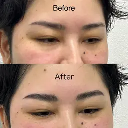 ハリウッドブロウリフト(HBL)