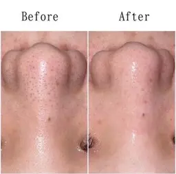 【🎀初回限定🎀】ハイドロ毛穴洗浄✨️黒ずみ除去＆つるん肌体験