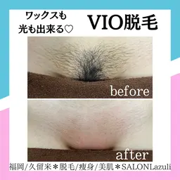 【当日予約限定／女性】年齢問わず人気！初めてのVIOワックス＋光脱毛応援！¥14,300→¥7,980